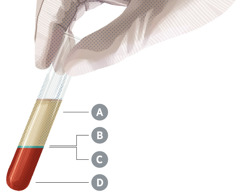 Ein Reagenzglas mit zentrifugiertem Blut; die vier Hauptbestandteile haben sich voneinander getrennt und sind mit A, B, C und D gekennzeichnet.