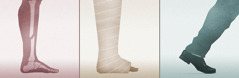 Collage: 1. Et røntgenbillede af et brækket ben. 2. Et ben i gips. 3. Et rask ben der går.