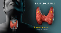 Samsett mynd: Skýringarmynd af skjaldkirtlinum. 1. Skjaldkirtillinn séður að framan þar sem hann er staðsettur í hálsinum. 2. Á bakhlið skjaldkirtilsins má sjá kalkkirtlana.